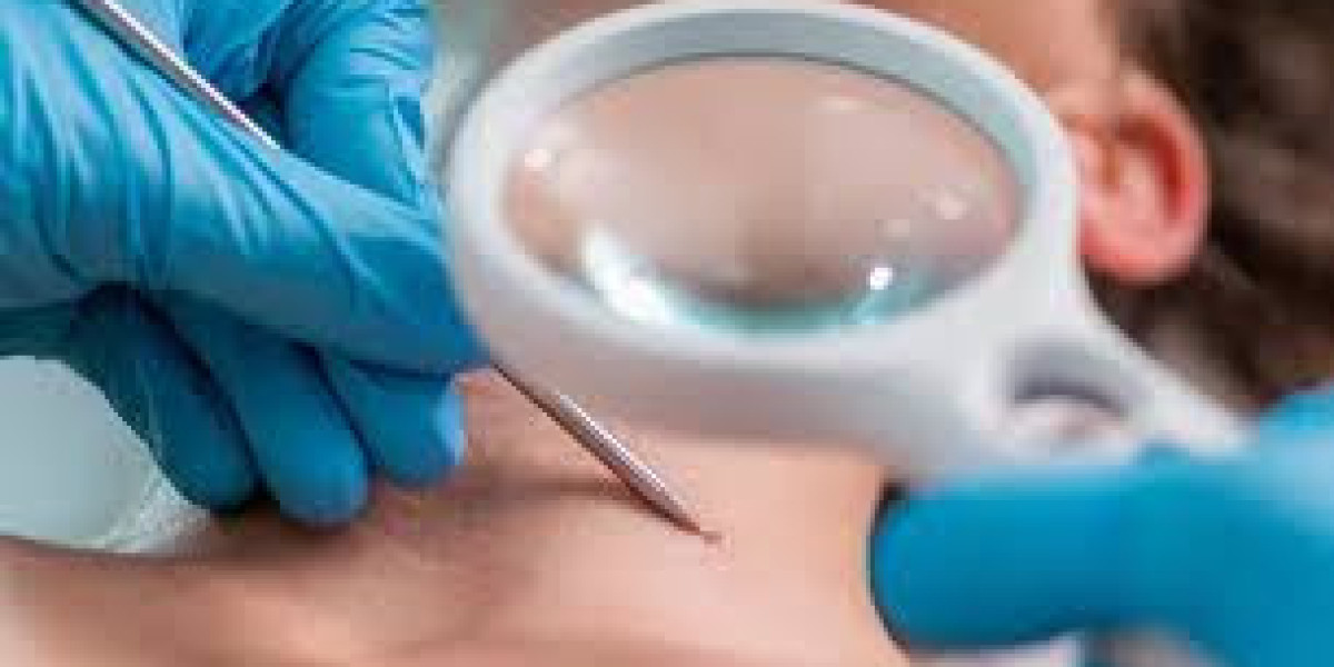 Expert Mole Removal Clinics in London: Dermatologist-Approved Options