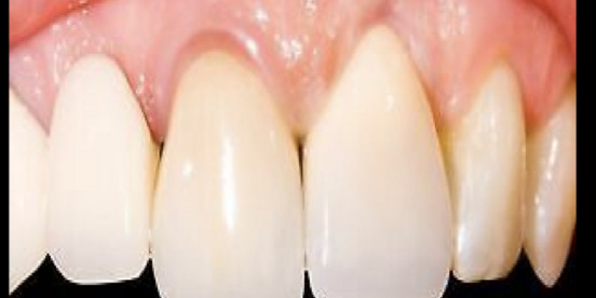 Soft Tissues Around Dental Implants in Tottenham